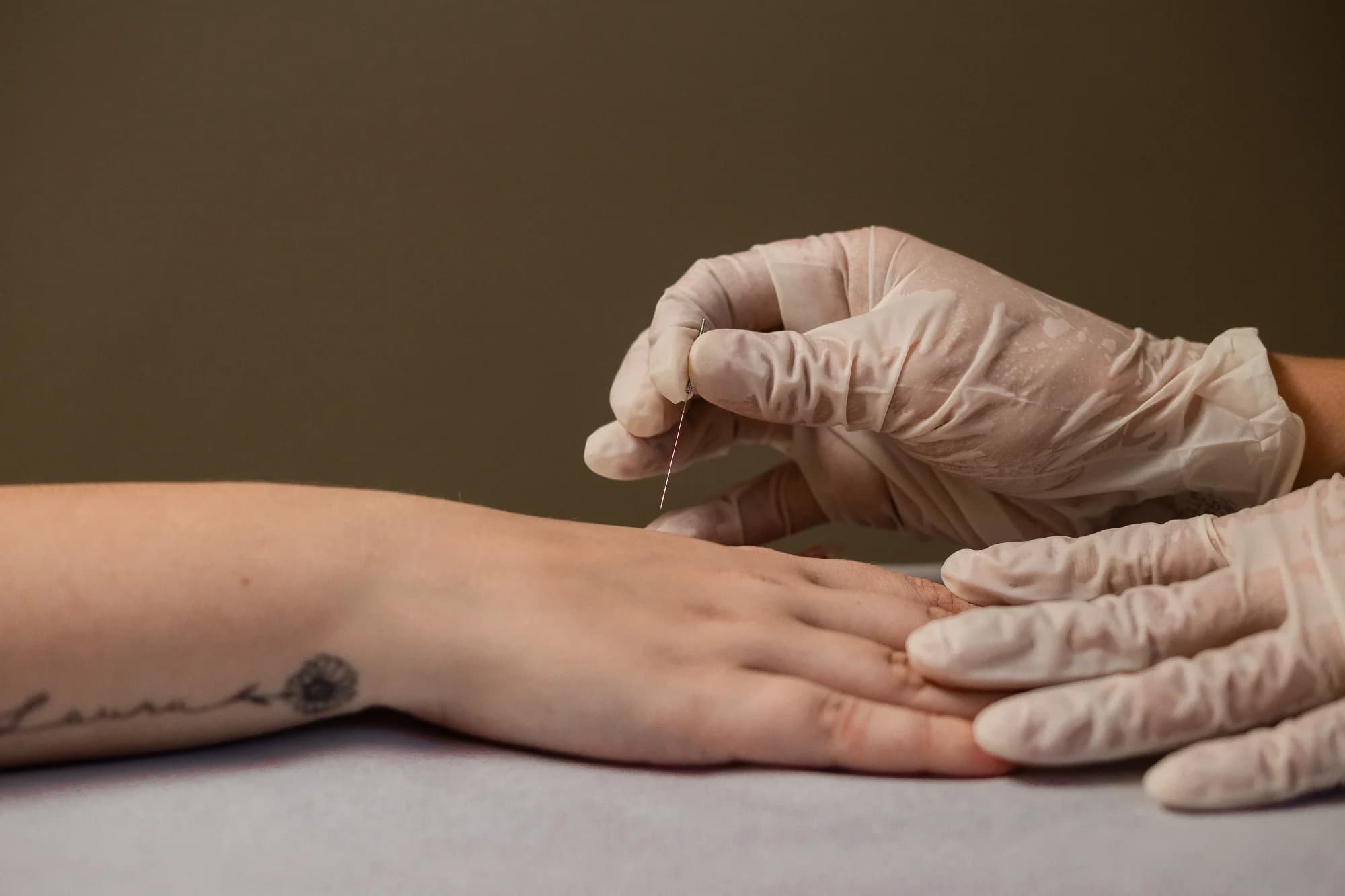 Sessão de acupuntura no Espaço Cor, com agulha sendo aplicada na mão da cliente